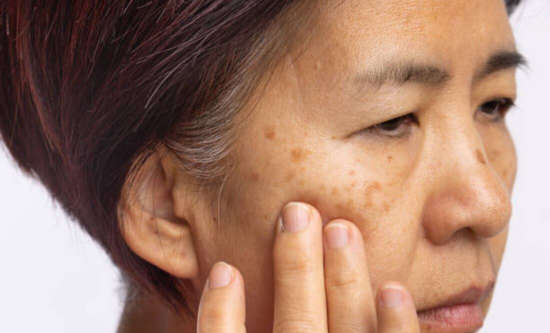 Manchas en el cutis: cómo se relacionan con el estrés crónico