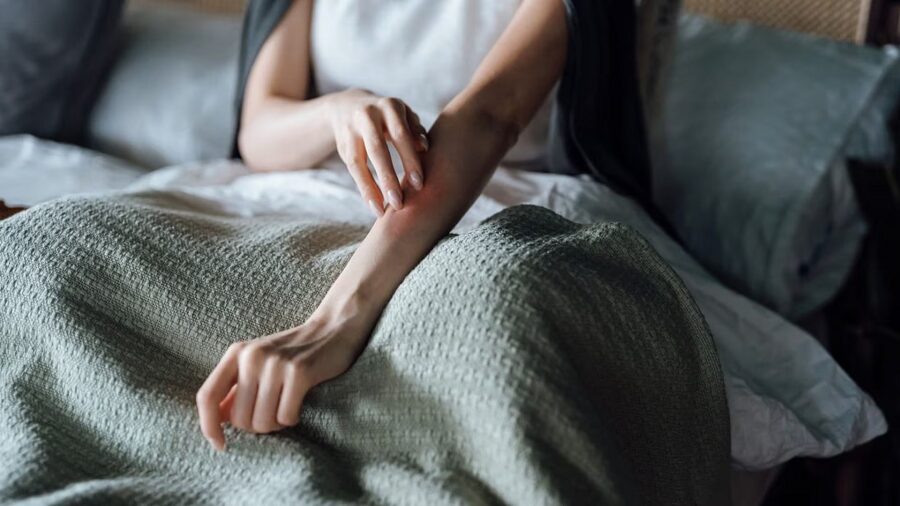 Brotes de psoriasis son más propensos en temporadas frías