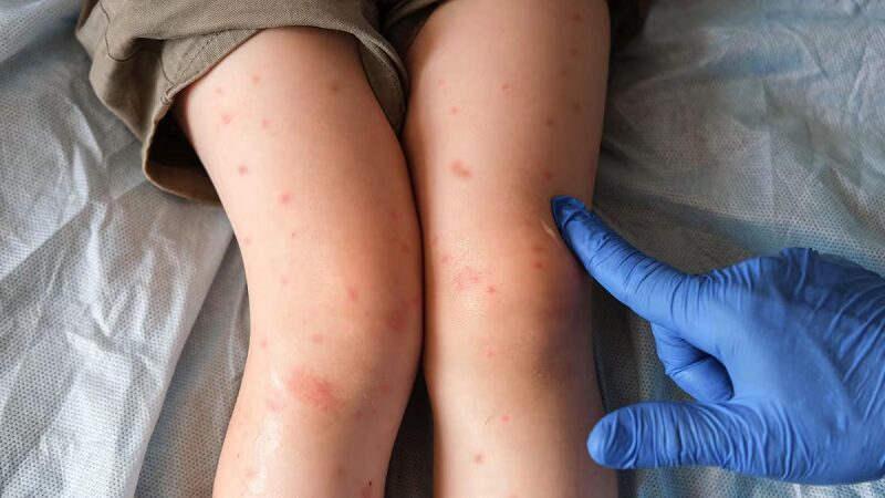 Estados Unidos podría perder estatus de país libre de sarampión