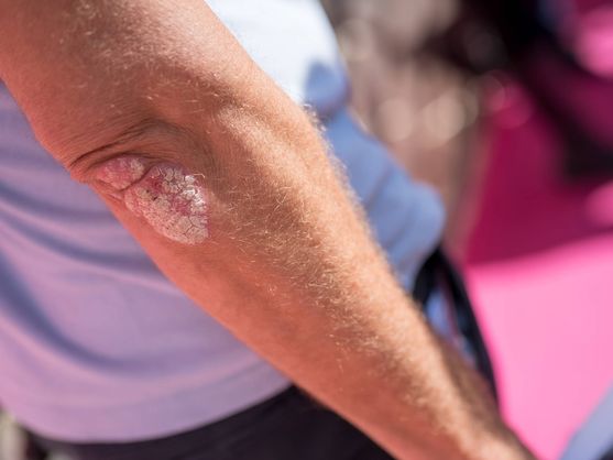 Tratamiento innovador abre nueva esperanza contra la psoriasis