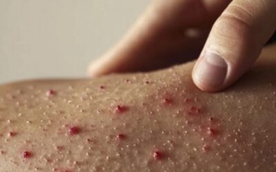 Brote de sarampión en Spartanburg: situación actual y cómo protegerse