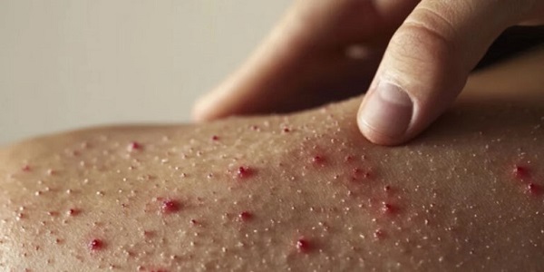 Brote de sarampión en Spartanburg: situación actual y cómo protegerse 