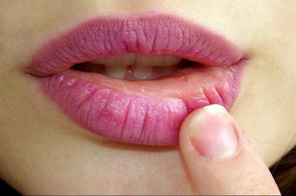 herpes en los labios