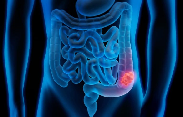 Cáncer de colon: 5 síntomas que no debes ignorar
