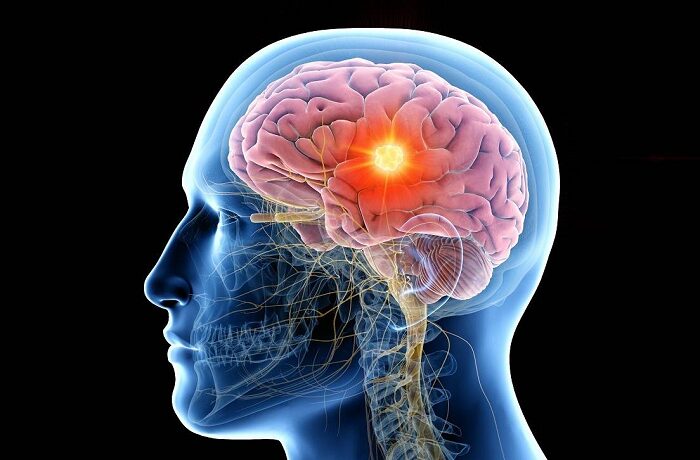 ¿Estrés o cáncer cerebral? 6 síntomas que no debes ignorar