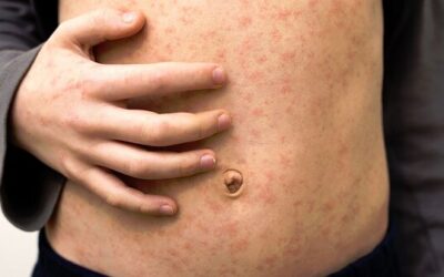 Sarampión: la enfermedad que puede borrar la memoria del sistema inmunológico