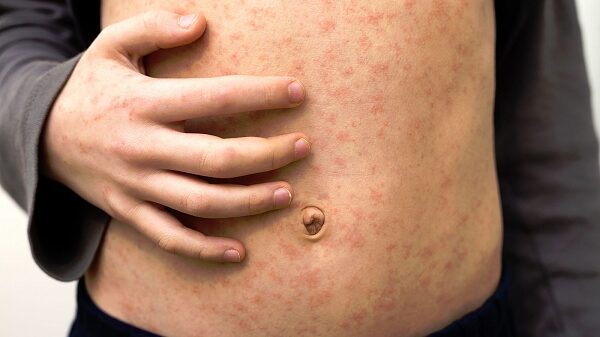 Sarampión: la enfermedad que puede borrar la memoria del sistema inmunológico