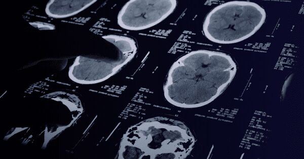 neuralgia del trigémino