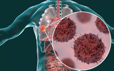 Nuevo hallazgo sobre replicación del cáncer de pulmón de células pequeñas