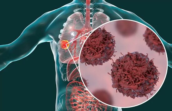 Nuevo hallazgo sobre replicación del cáncer de pulmón de células pequeñas