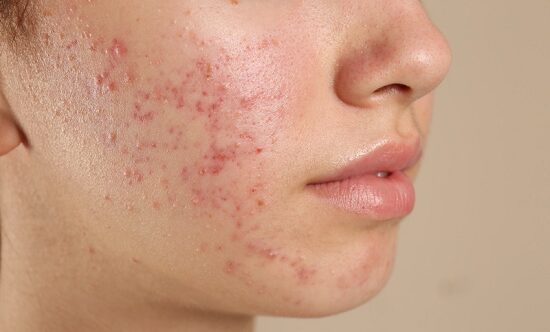 Alimentos que provocan acné: aprende y cuida la piel