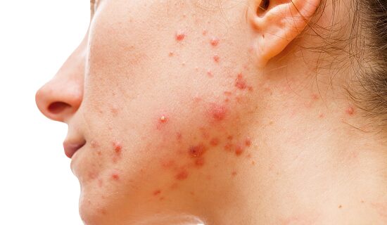 acné 