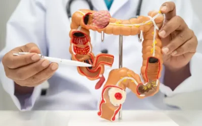 Aspirina y cáncer intestinal: hallazgo prometedor