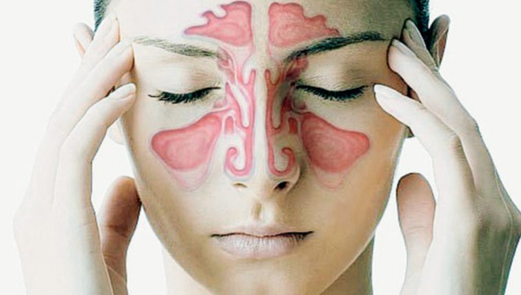  sinusitis