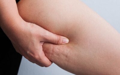 Tratamientos novedosos para disminuir la celulitis y mejorar la piel