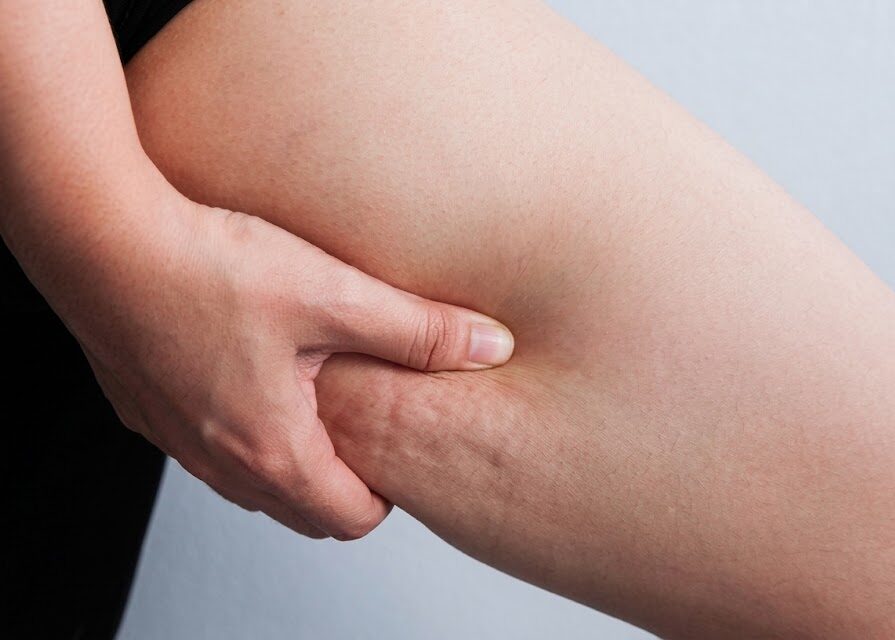 Tratamientos novedosos para disminuir la celulitis y mejorar la piel