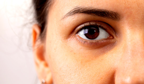 ojeras