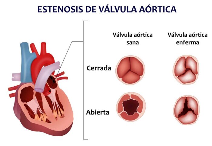 estenosis aórtica