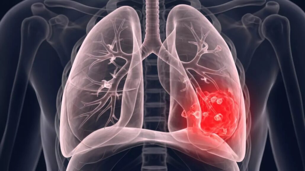 adenocarcinoma tipo de cáncer que enfrentó el papa León XIV