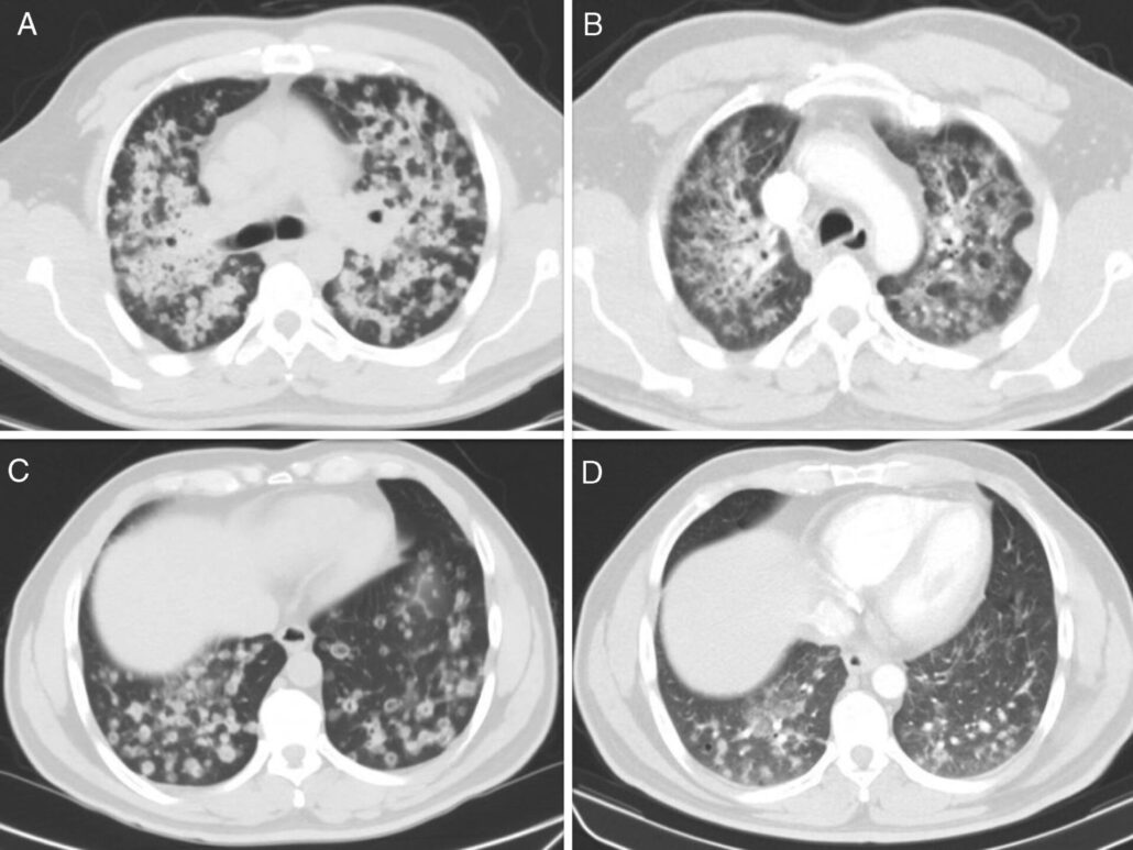 adenocarcinoma tipo de cáncer que enfrentó el papa León XIV